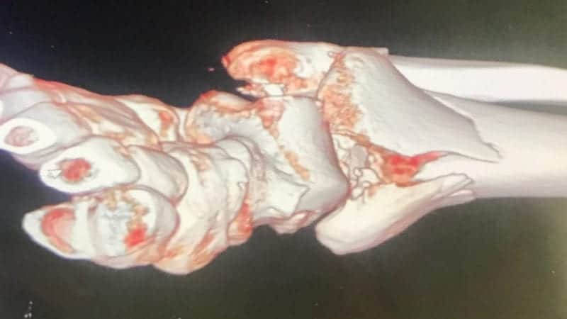 A 3D scan of Cal Crutchlow's ankle in 2018