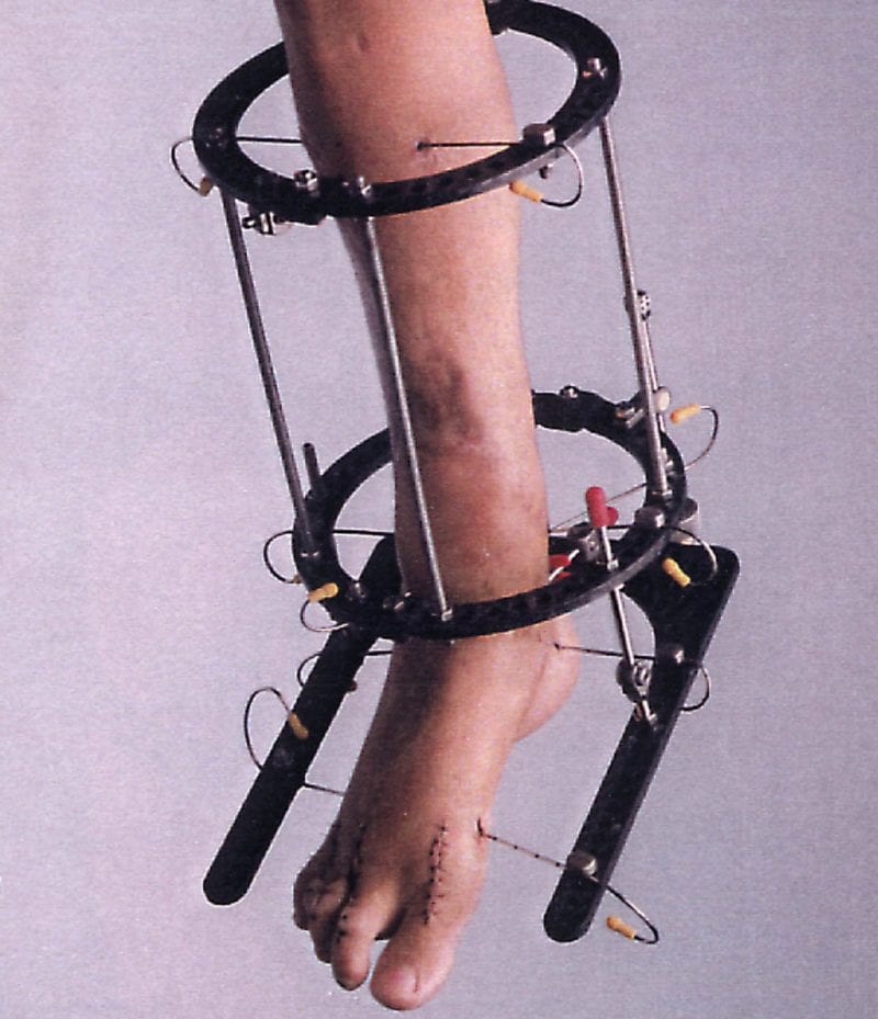 1993 – Doohan leg in Ilizarov frame (8) – Copy