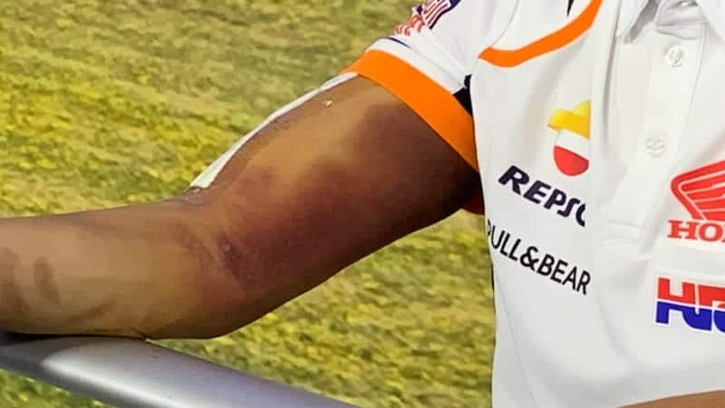 Marc Marquez's arm, MotoGP Jerez 2020